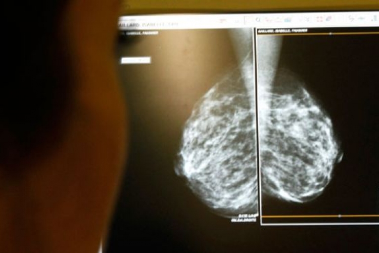 3D mammográfiával könnyebben felismerhető a mellrák